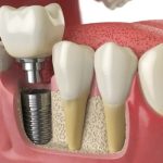 What Is the Procedure For Same Day Dental Implants