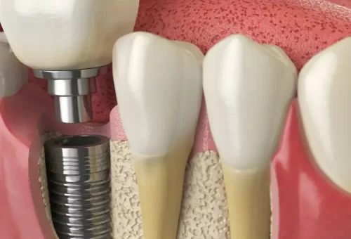 What Is the Procedure For Same Day Dental Implants